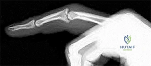 Orthopedic Surgery MCQs: Trauma, Hip Arthroplasty & Elbow | Part 153