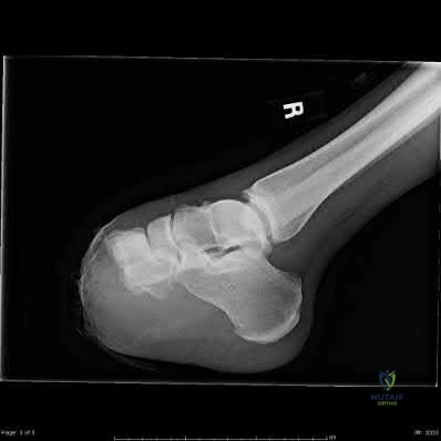 OITE & ABOS Orthopedic Board Prep: Practice Exam Part 90