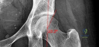 Orthopedic Surgery Board Review MCQs: AAOS Master Bank Part 169