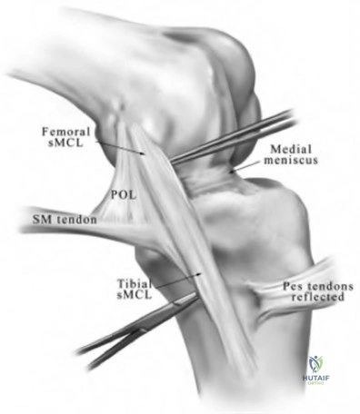 Orthopedic Surgery Board Review MCQs: AAOS Master Bank Part 171