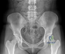 Orthopedic Surgery Board Review MCQs: AAOS Master Bank Part 173