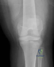 Orthopedic Surgery Board Review MCQs: AAOS Master Bank Part 175
