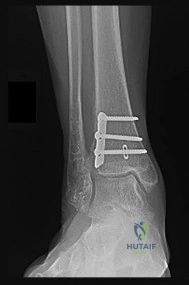 Orthopedic Surgery Board Review MCQs: AAOS Master Bank Part 183