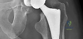 Orthopedic Surgery Board Review MCQs: AAOS Master Bank Part 187
