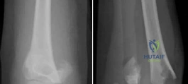 Orthopedic Surgery Board Review MCQs: AAOS Master Bank Part 237