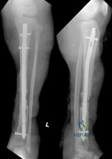 Orthopedic Surgery Board Review MCQs: AAOS Master Bank Part 249