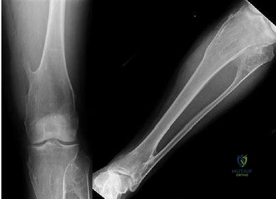 Orthopedic Surgery Board Review MCQs: AAOS Master Bank Part 163