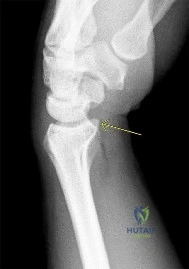OITE & ABOS Orthopedic Board Prep: Practice Exam Part 188