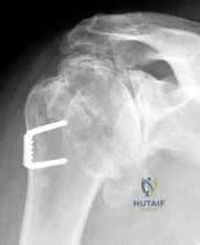 Orthopedic Surgery Board Review MCQs: AAOS Master Bank Part 85