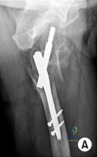 Orthopedic Surgery Board Review MCQs: Ankle & Trauma Fractures - Part 95