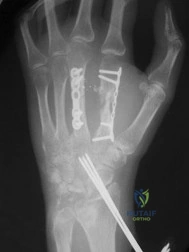 Orthopedic Surgery Board Review MCQs: AAOS Master Bank Part 99