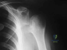 OITE & ABOS Orthopedic Board Prep MCQs: Foot & Ankle, Trauma & Shoulder | Part 110