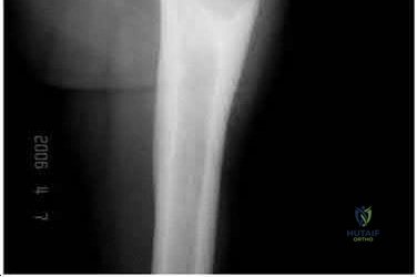 OITE & ABOS Orthopedic Board Prep: Practice Exam Part 130