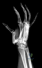 Orthopedic MCQs: Find the Correct Answer for the Patient's Case