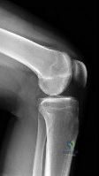 OITE & ABOS Orthopedic Board Prep: Practice Exam Part 154