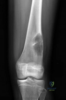 OITE & ABOS Orthopedic Board Prep: Practice Exam Part 160