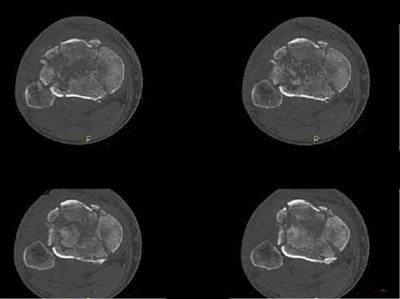 Orthopedic Board Review MCQs: Arthroplasty, Spine & Pediatrics | Part 78