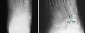 OITE & ABOS Orthopedic Board Prep: Practice Exam Part 190