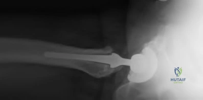 OITE & ABOS Orthopedic Board Prep: Practice Exam Part 192