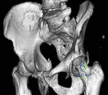 OITE & ABOS Orthopedic Board Prep: Practice Exam Part 204