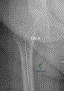 OITE & ABOS Orthopedic Board Prep: Practice Exam Part 196