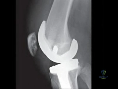 OITE & ABOS Orthopedic Board Prep: Practice Exam Part 230