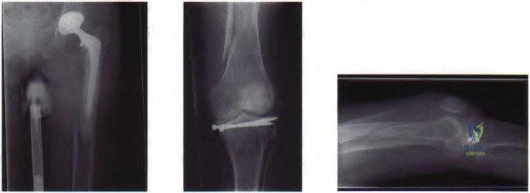 OITE & ABOS Orthopedic Board Prep: Practice Exam Part 146