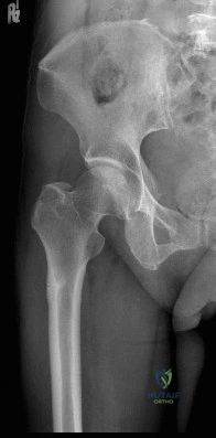 OITE & ABOS Orthopedic Board Prep: Practice Exam Part 174