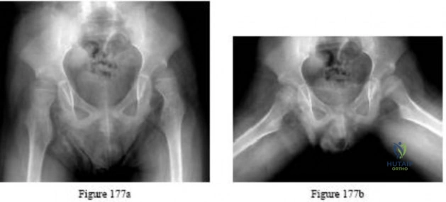 Orthopedic Board Review MCQs: Deformity, Foot, & Fracture | Part 252