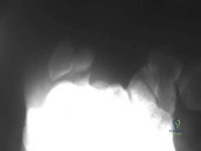 OITE & ABOS Orthopedic Board Prep: Practice Exam Part 254