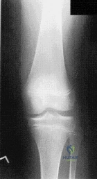 Orthopedic Surgery Board Review MCQs: Arthroplasty, Ligament & Spine | Part 149