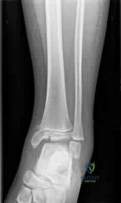 OITE & ABOS Orthopedic Board Prep: Practice Exam Part 260