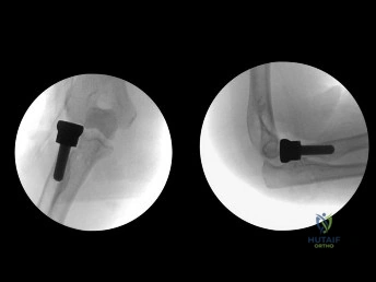 Orthopedic Surgery Board Review MCQs: AAOS Master Bank Part 233