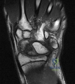 OITE & ABOS Orthopedic Board Prep: Practice Exam Part 34