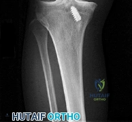 OITE & ABOS Orthopedic Board Prep: Practice Exam Part 56