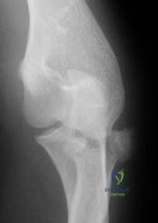 OITE & ABOS Orthopedic Board Prep: Practice Exam Part 94