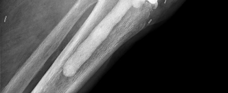 Orthopedic Board Review MCQs: Adult Reconstruction & Trauma - Part 98