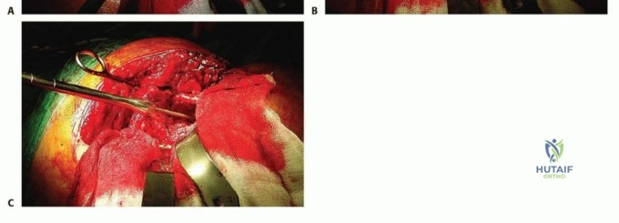 الدليل الشامل لعلاج تقفع دوبويتران من التشخيص إلى التعافي