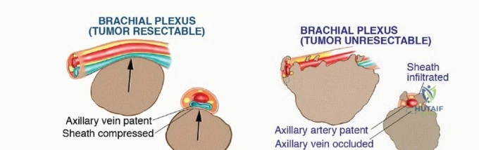 صورة توضيحية لـ كسور عظم العضد القريب: دليل شامل للمرضى من الأسباب إلى التعافي مع الأستاذ الدكتور محمد هطيف