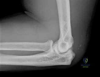 صورة توضيحية لـ آلام المرفق المعقدة: فهم وعلاج وتر الكاربوس الزندي القصير وغيرها من إصابات المرفق مع الأستاذ الدكتور محمد هطيف