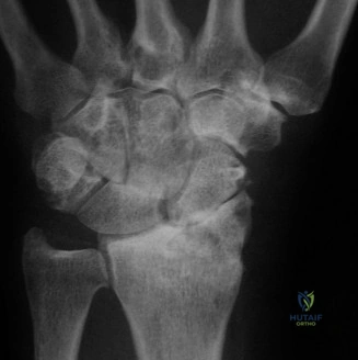 صورة توضيحية لـ علاج كسور الرسغ المعقدة: دليلك الشامل مع الأستاذ الدكتور محمد هطيف في صنعاء