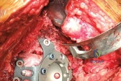 صورة طبية: استبدال مفصل الورك الكلي في كسور الحُقّ الحادة: نظام الأخطبوط – الحل الأمثل في صنعاء