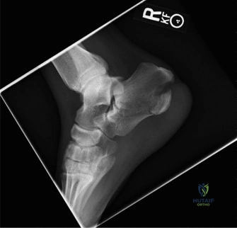 التهاب مفصل الكاحل المعقد بعد الصدمة: علاج التشوهات وسوء وعدم الالتئام