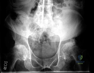 صورة توضيحية لـ شلل العصب الوركي بعد تغيير مفصل الورك: دليل شامل للمرضى