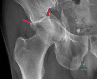 صورة توضيحية لـ كسور الحق المعقدة لدى كبار السن: دليل شامل للتشخيص والعلاج مع الأستاذ الدكتور محمد هطيف