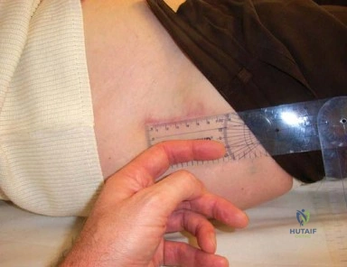 صورة توضيحية لـ النهج الأمامي الجانبي في استبدال مفصل الورك بالتدخل المحدود: دليل شامل للمرضى مع الأستاذ الدكتور محمد هطيف