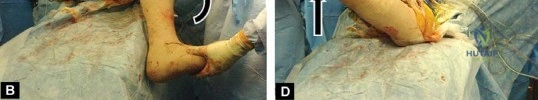 صورة توضيحية لـ إتقان توازن الأنسجة الرخوة لمفصل ورك صناعي مثالي: دليل شامل للمرضى مع الأستاذ الدكتور محمد هطيف
