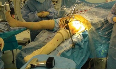 صورة توضيحية لـ المقاربة الأمامية لاستبدال مفصل الورك الكلي: دليل شامل للتعافي السريع مع الأستاذ الدكتور محمد هطيف في صنعاء