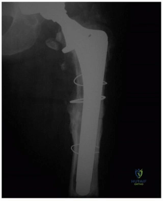 صورة توضيحية لـ مراجعة مفصل الورك: لماذا تتفوق الدعامات الأسطوانية المطلية بالمسام بشكل كامل؟