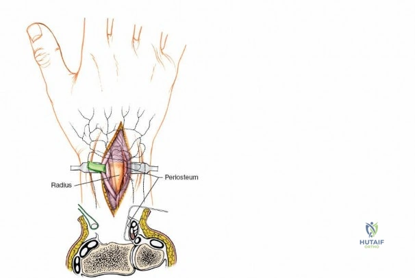 صورة توضيحية لـ تقييم آفة الجذور العصبية: دليل شامل لمشاكل الجذع والساق مع الأستاذ الدكتور محمد هطيف